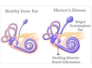 MENIERE'Meniere's Treatment | Best ENT Specialist | Dr. Seemab ShaikhS DISEASE| Hearing aid center in pune